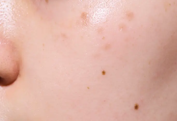 使用前臉頰斑點與瑕疵明顯